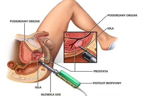 Operacja prostaty ile dni w szpitalu? Poznaj czas hospitalizacji