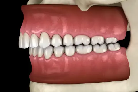 Vista laterale di denti con malocclusione dentale, i denti superiori sporgono notevolmente su quelli inferiori, un sintomo comune.