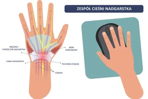 Ilustracja pokazuje anatomię dłoni z zaznaczonym kanałem nadgarstka, nerwem pośrodkowym i ścięgnami, wyjaśniając zespół cieśni nadgarstka. Dłoń trzyma myszkę komputerową.
