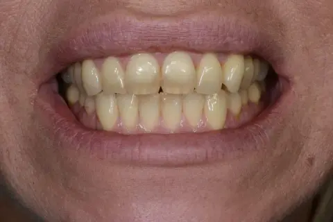 Denti ingialliti, forse a causa della clorexidina. La bocca è aperta, mostrando un sorriso.