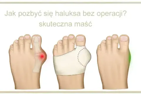 Haluksy: Szybka ulga, leczenie bez operacji i ćwiczenia. Kompletny przewodnik.