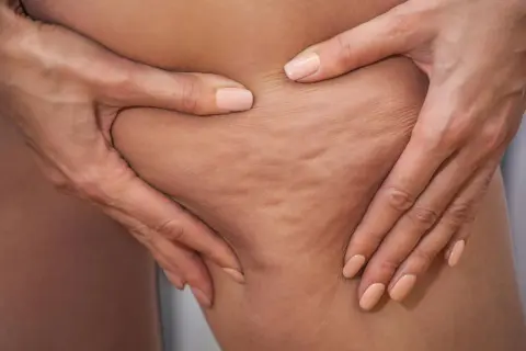 Hände greifen in die Haut, um Cellulite zu zeigen. Viele fragen sich, ob und wie geht cellulite wieder weg.