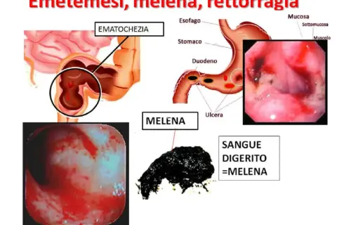Illustrazione medica che mostra ematochezia e melena, sintomi di sanguinamento gastrointestinale, inclusa la presenza di sangue nelle feci.