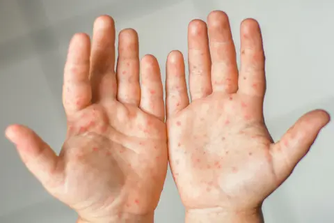 Hautausschlag an den Händen, möglicherweise durch eine Vitamin C-Allergie verursacht. Rote Flecken auf der Haut.