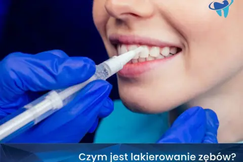 Profesjonalne lakierowanie zębów u dorosłych. Dentysta aplikuje środek wybielający na zęby pacjentki.