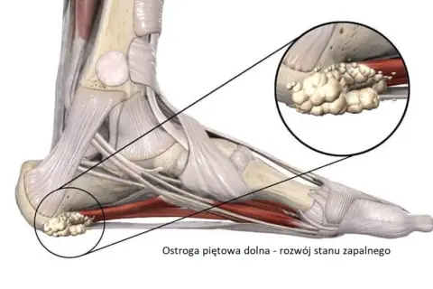Ostroga piętowa: do jakiego lekarza i jak leczyć?
