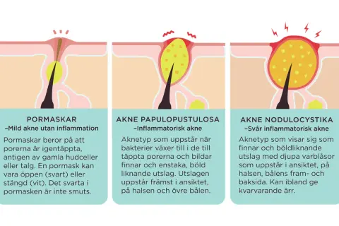 Illustrationer visar olika typer av akne, från pormaskar till svårare inflammationer. Lär dig hur man får bort finnar och vad som orsakar dem.