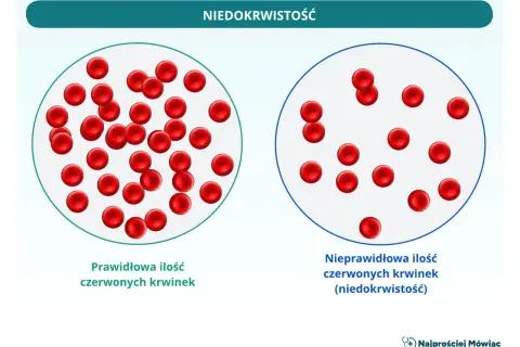 Porównanie prawidłowej i nieprawidłowej ilości czerwonych krwinek, czyli elementów morfotycznych krwi, w kontekście niedokrwistości.