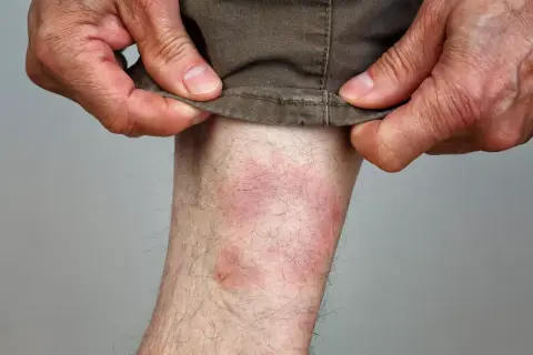 Rote, gereizte Haut am Bein, die auf einen Zeckenbiss hindeutet. Hände ziehen die Hose hoch.