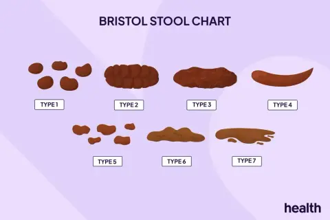Wykres Bristolskiej Skali Stolca pokazuje 7 typów, od twardych grudek (typ 1) po płynne (typ 7). Typ 6 i 7 mogą wskazywać, ile trwa biegunka.