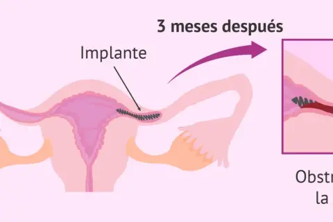 Ilustración muestra un implante en la trompa de Falopio, que causa obstrucción. Esto es un método de ligadura de trompas.