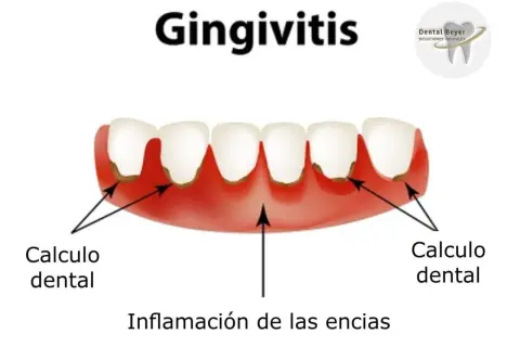 Ilustración de gingivitis con cálculo dental y encias muy inflamadas.