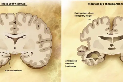 Porównanie mózgu zdrowego i z chorobą Alzheimera. Widoczne zmniejszenie hipokampa i kory mózgowej, co jest jedną z przyczyn choroby.