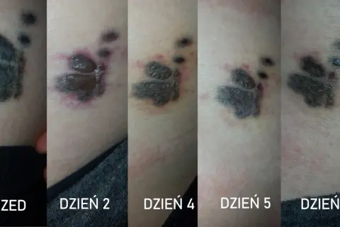 Postęp usuwania tatuażu łapy: od świeżej rany po gojenie. Dzień 2, 4, 5, 7.