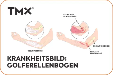Vergleich gesunder und entzündeter Sehnen am Ellenbogen, der Golferellenbogen-Symptome zeigt. Kleine Risse in den Sehnen sind sichtbar.