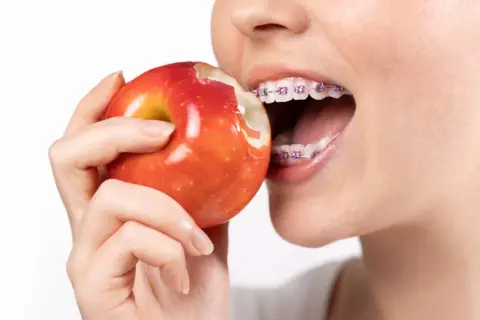 Mentre si morde una mela rossa, si vedono i denti con l'apparecchio. Un esempio di cosa mangiare con l'apparecchio, con cautela.