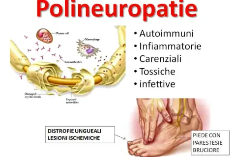 Illustrazione delle polineuropatie: cause autoimmuni, infiammatorie, carenziali, tossiche, infettive. Danno alla guaina mielinica e al nervo. Piede con parestesie.