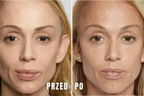 Przed i po zabiegu z użyciem kwasu polimlekowego stymulatora. Skóra twarzy jest gładsza, bardziej napięta i odmłodzona.