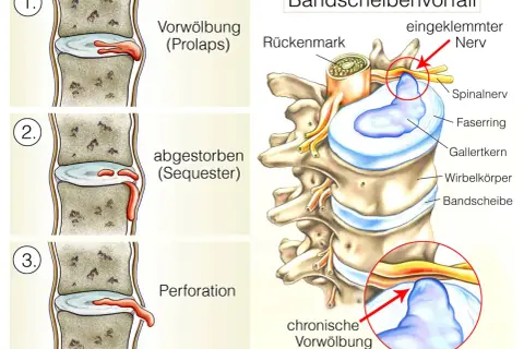 Illustration zeigt die Stadien einer Bandscheibenprotrusion LWS: Vorwölbung, abgestorbener Teil (Sequester) und Perforation, die zu einem eingeklemmten Nerv führen.
