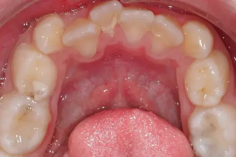 Vista ravvicinata dell'arcata dentale inferiore con evidente affollamento dentale inferiore. Si notano denti leggermente storti e sovrapposti.