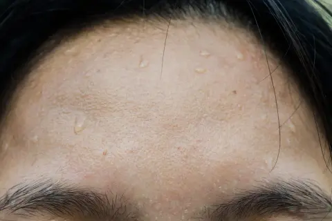 Gouttes de sueur sur le front, signe de transpiration excessive du visage après un effort.