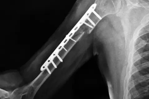Złamanie kości: Kiedy start rehabilitacji? Nie trać czasu!