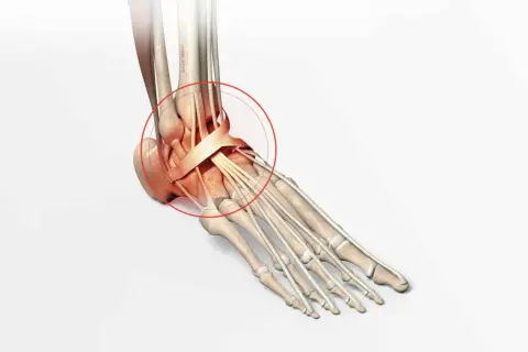 Illustration anatomique du pied montrant les conséquences d'une fracture mal soignée, avec une zone rouge entourant les tendons et ligaments de la cheville.