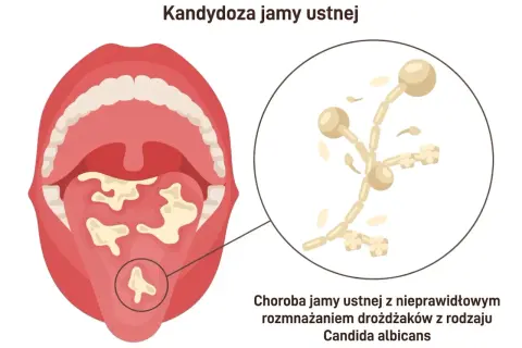 Grzybica jamy ustnej po antybiotyku: białe naloty na języku i podniebieniu, powiększony obraz drożdżaków Candida albicans.