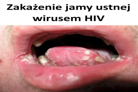 Zakażenie jamy ustnej wirusem HIV objawia się m.in. nalotem na języku i pleśniawkami.