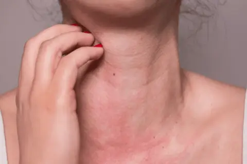 Alergia na słońce: objawy, przyczyny i jak sobie z nią radzić?