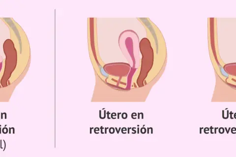 Ilustración comparativa de la posición del útero: anteversión (normal), útero en retroversión y útero en retroversoflexión.