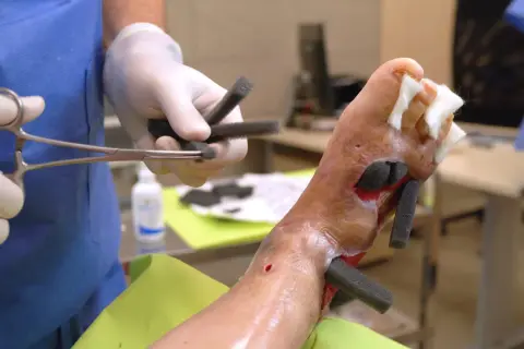 Medyk przygotowuje opatrunki podciśnieniowe do aplikacji na stopę pacjenta.