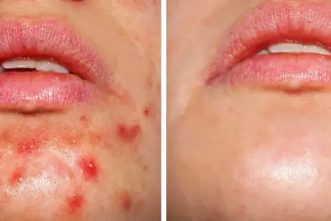 Przed i po: kwas salicylowy peeling skutecznie redukuje wypryski i zaczerwienienia wokół ust, przywracając gładkość skóry.