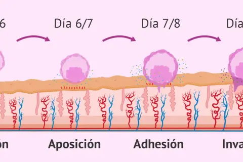 Ilustración de la implantación embrionaria: eclosión, aposición, adhesión e invasión del blastocisto en el endometrio.