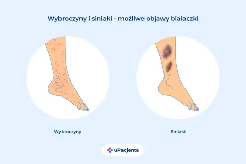 Ilustracja przedstawia nogę z wybroczynami i siniakami, jako możliwe objawy białaczki.