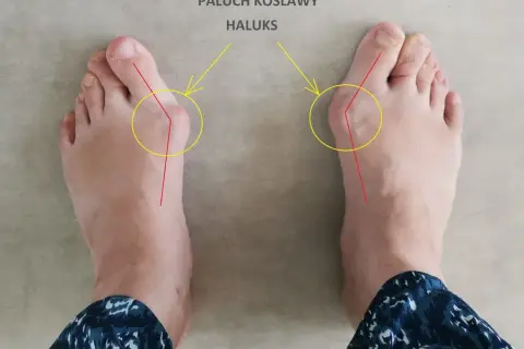 Do jakiego lekarza z haluksami? Ortopeda, podolog, fizjoterapeuta