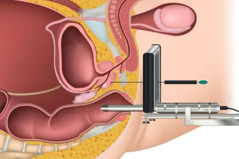 Darstellung einer MRT-gestützten Biopsie der Prostata. Ein Gerät wird in den Enddarm eingeführt, um die Prostata zu erreichen.