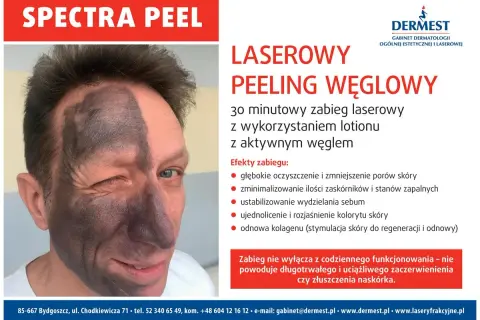 Mężczyzna z połową twarzy pokrytą czarną maską węglową po zabiegu Spectra Peel. Laserowy peeling węglowy nie powoduje skutków ubocznych jak zaczerwienienie czy złuszczanie.