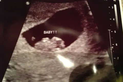 Ecografía temprana con la palabra "BABY!!" escrita. La posición del saco gestacional podría ser analizada con el método Ramzi.