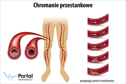 Chromanie przestankowe: Ćwiczenia, które cofną ból i przywrócą ruch