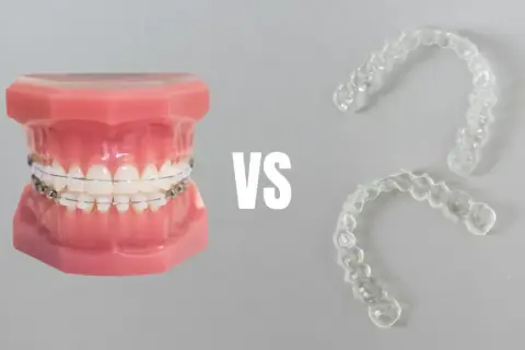 Aparat na zęby dla dzieci: Jak wygląda? Ruchomy vs. stały
