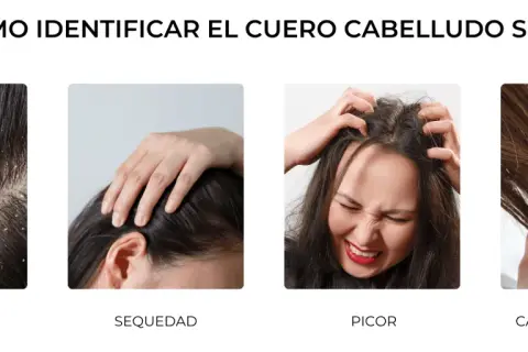 Cuatro imágenes muestran síntomas de cuero cabelludo seco: descamación, sequedad, picor y cabello sin brillo.