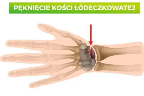 Złamana kość łódeczkowata nadgarstka, zaznaczona czerwoną strzałką.