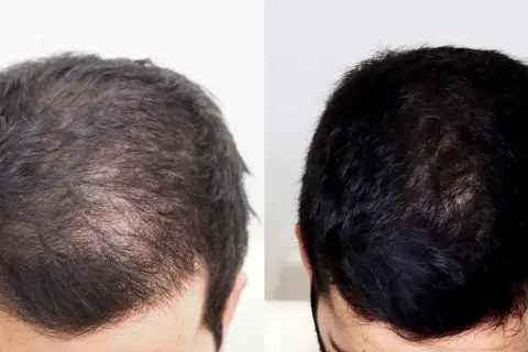 Comparativa de mesoterapia capilar antes y después: cabello más denso y oscuro.