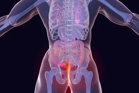Anatomische Darstellung des menschlichen Körpers mit Hervorhebung des Enddarms. Mögliche analkrebs symptome werden hier visuell dargestellt.