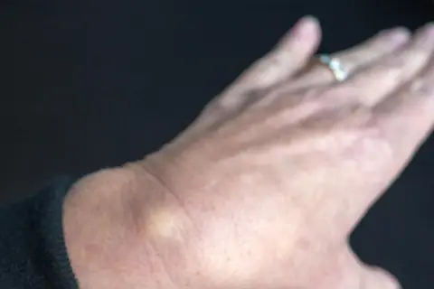 Ein kleiner, gelblicher Schleimbeutel am Handgelenk einer Person mit einem Ring.