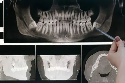 Radiographie dentaire montrant une dent de sagesse impactée, indiquant la nécessité d'une extraction.