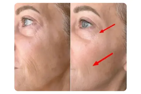 Avant/après : le masque LED a réduit les rides du visage, comme indiqué par les flèches rouges.