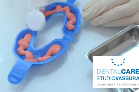 Applicazione di gel per fluoro profilassi in un portaimpronte dentale.