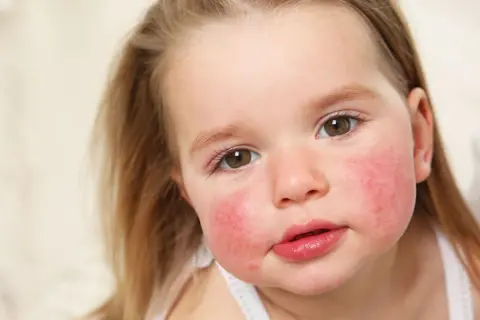 Alergia pokarmowa u dzieci: objawy, diagnoza i co robić?